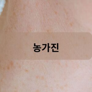 농가진