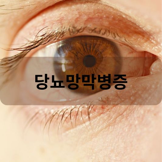 당뇨망막병증: 원인, 증상, 치료 방법 알아보기!