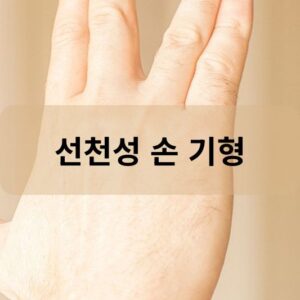 선천성 손 기형