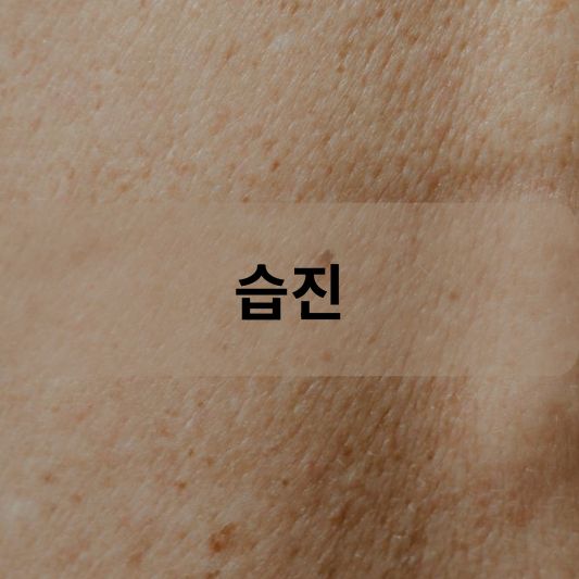 습진: 원인, 증상, 치료 방법 알아보기!