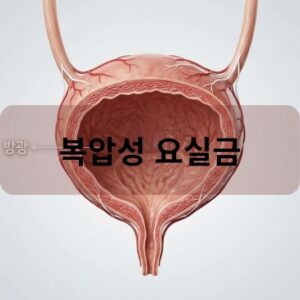 복압성 요실금