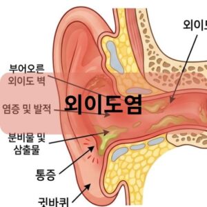 외이도염