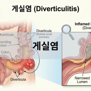 게실염
