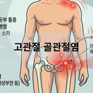 고관절 골관절염