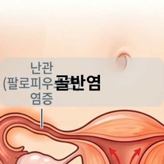 골반염 증상: 원인, 진단 방법, 치료 방법 알아보기!